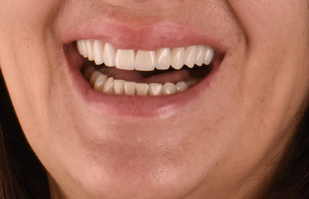 before after fatete dentare cluj dr tomina