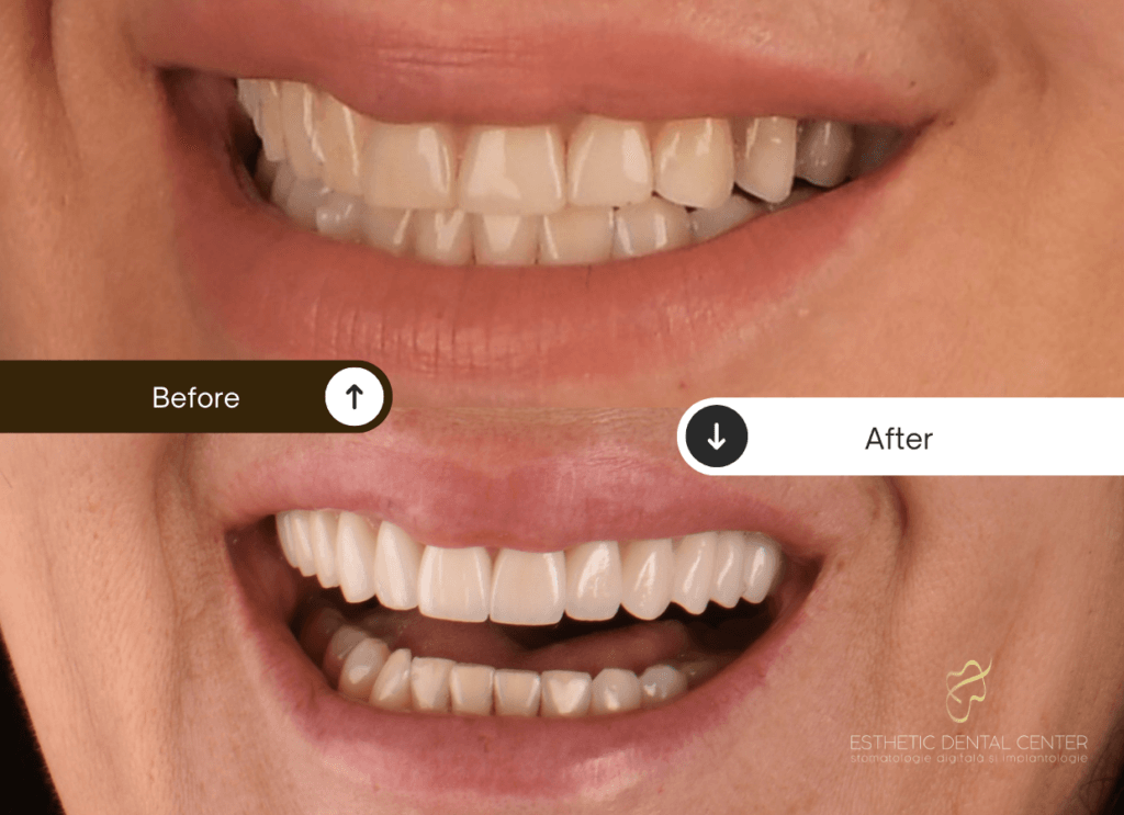 before after fatete dentare cluj dr tomina