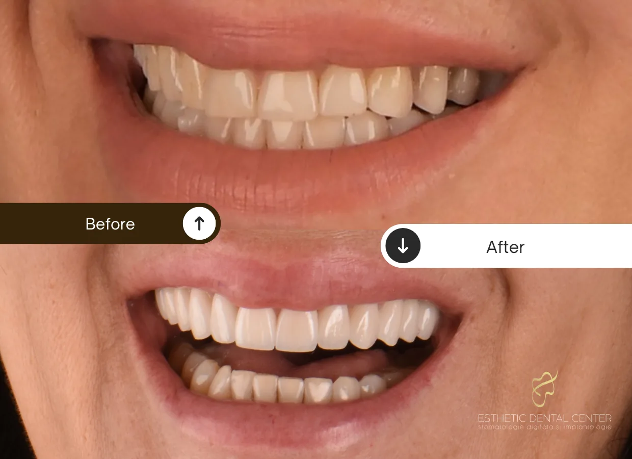 before after fatete dentare cluj dr tomina