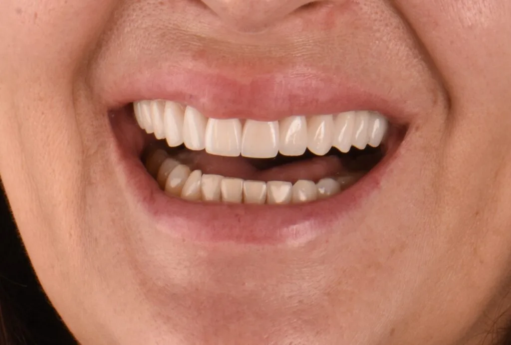 caz fatete dentare