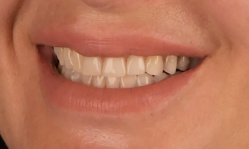 before after fatete dentare cluj