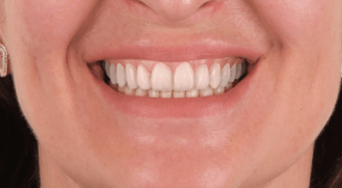 simulare AI zambet fatete dentare