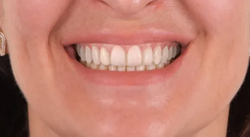 simulare AI zambet fatete dentare