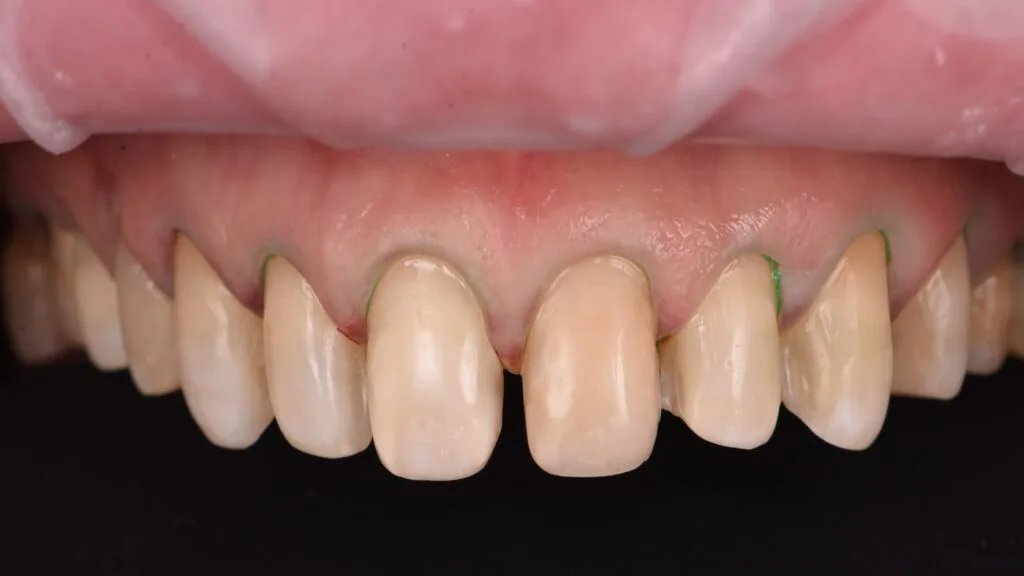 caz dentar complex fatete dentare