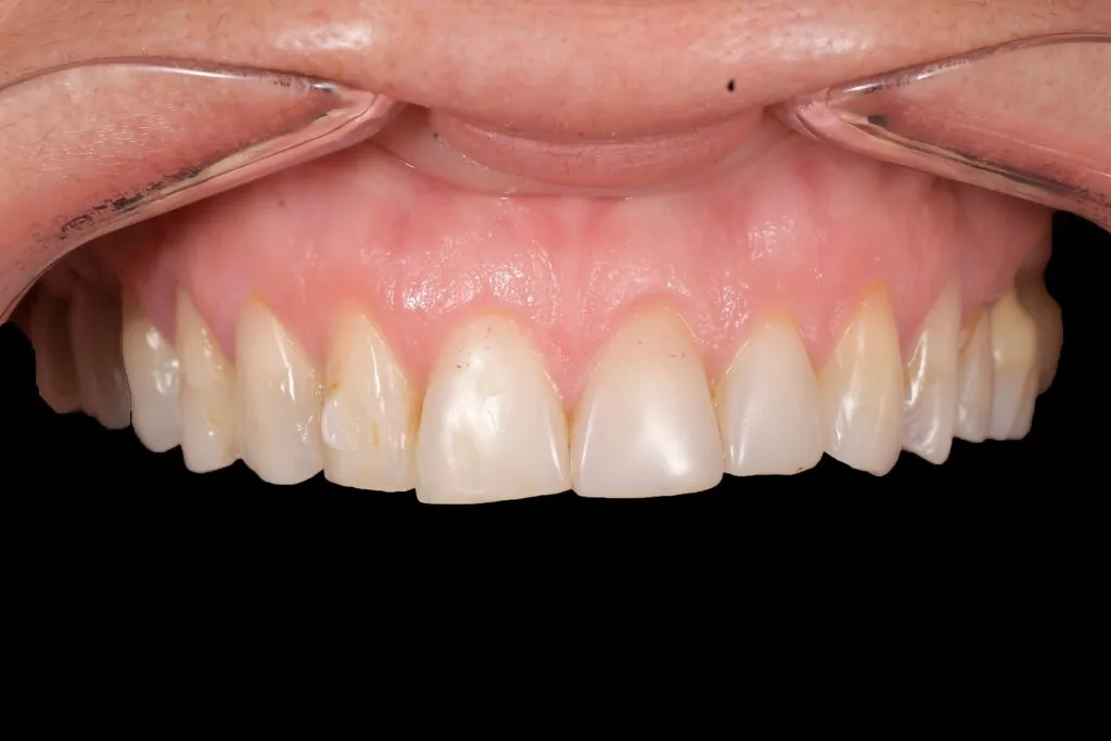 fatete dentare reale