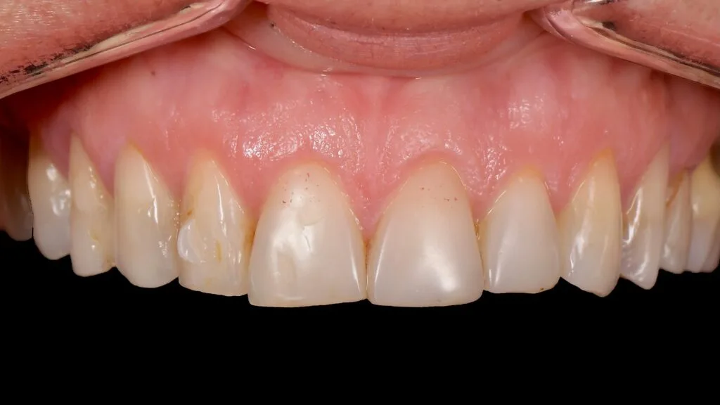 fatete dentare complexe