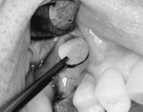 Vedere intraoperatorie — fereastră osoasă creată în peretele lateral al sinusului maxilar, pregătită pentru augmentarea osoasă.