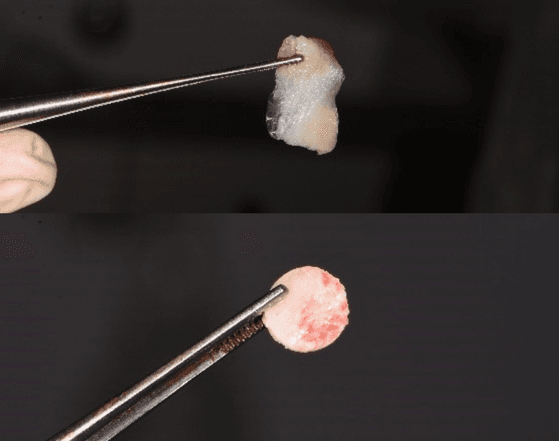 Materialele de sigilare folosite în protocolul de sinus lift: membrana rezorbabilă și capacul osos autolog obținut la crearea ferestrei osoase.