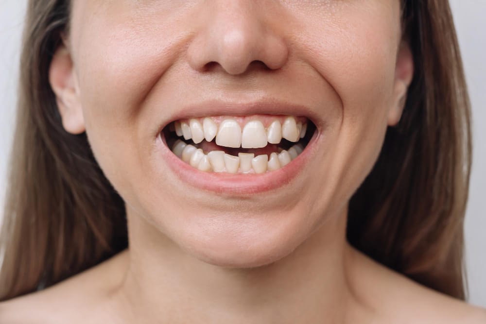 dinti inghesuiti suprapusi ortodont aparat dentar