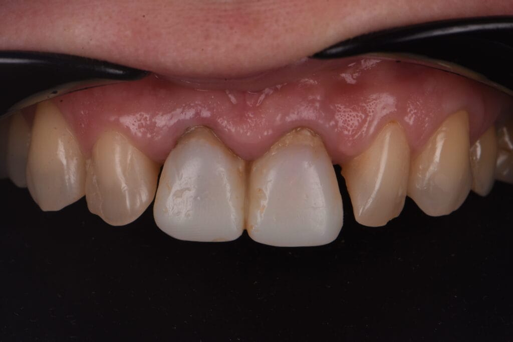 asanare dentara