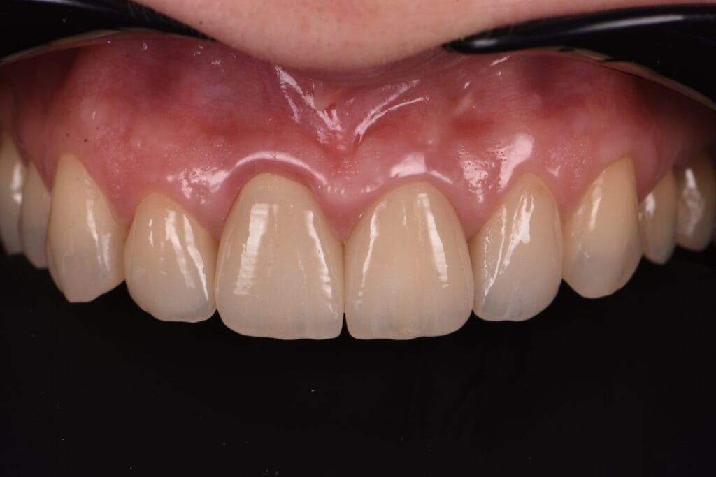 La 2 saptamani post-cimentare, tesuturile gingivale s-au vindecat, restaurarile ceramice sunt integrate armonios in contextul dentar si gingival.