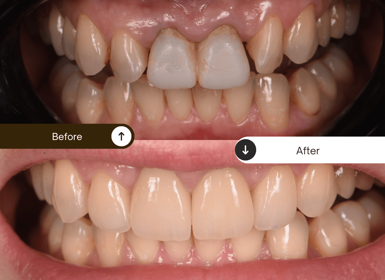 before after caz coroane ceramice