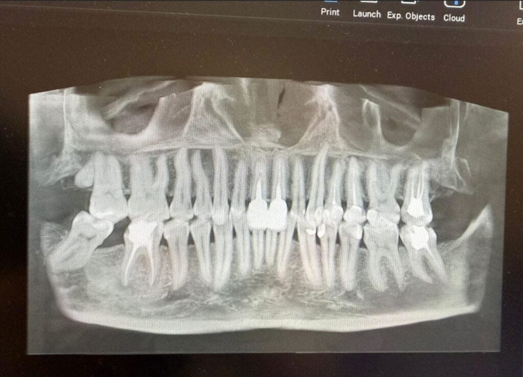 Radiografie panoramică