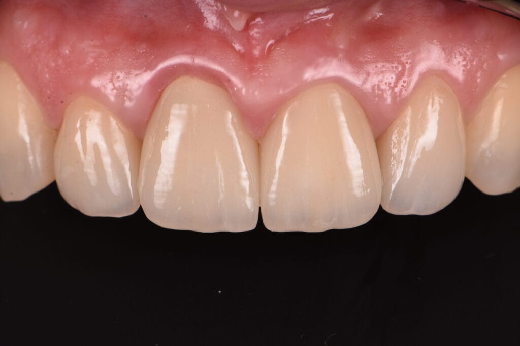 coroane ceramice dentare cluj-napoca cluj